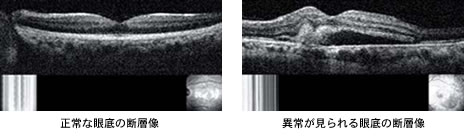 正常な眼底の断層像と異常が見られる眼底の断層像